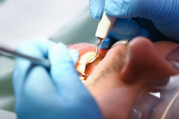 Best Knocked-Out Tooth (Avulsed Tooth) Treatment in Fredericktown, OH