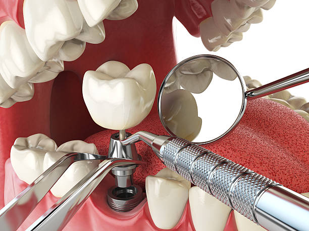Best Emergency Cosmetic Dentistry (e.g., broken veneers) in Fredericktown, OH